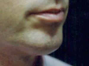 A result from Cosmetic Surgery Dallas