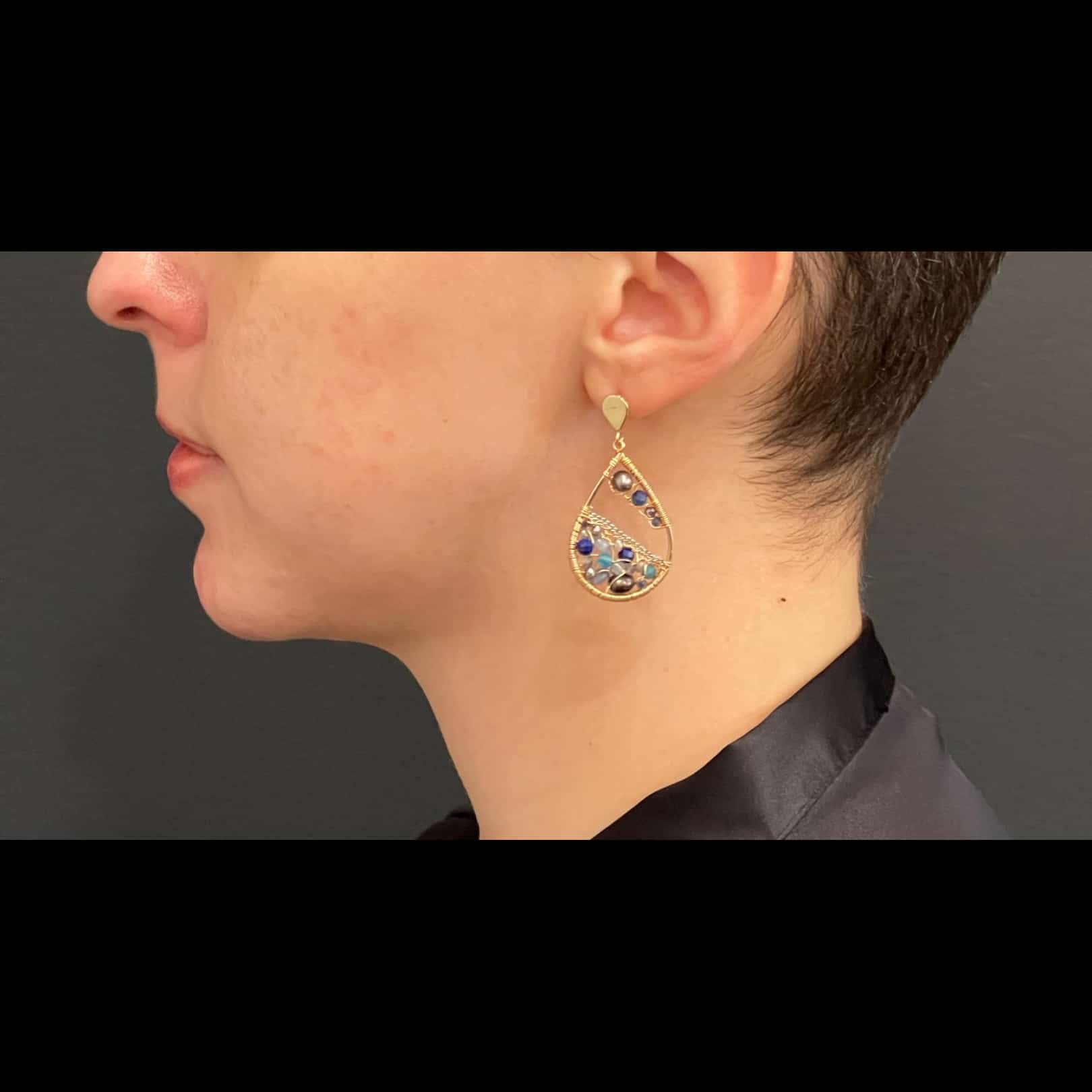 A result from Cosmetic Surgery Dallas