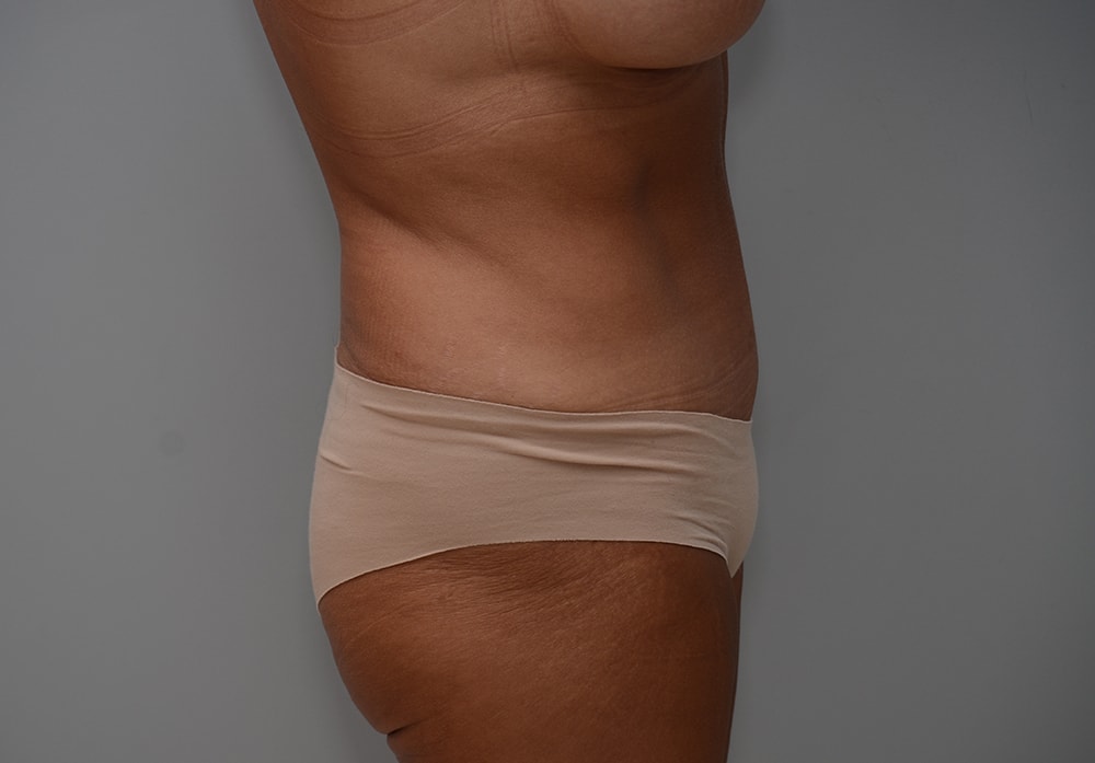 A result from JL Plastic Surgery