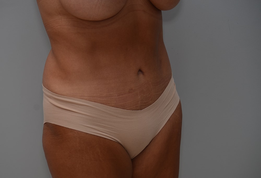 A result from JL Plastic Surgery