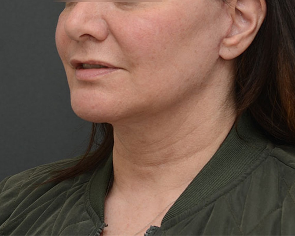 A result from JL Plastic Surgery