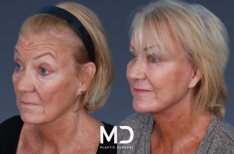 A result from MD Plastic Surgery