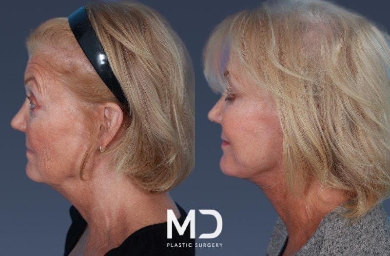 A result from MD Plastic Surgery