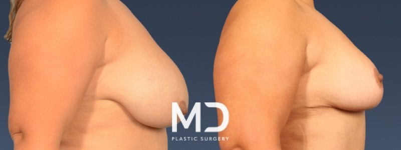 A result from MD Plastic Surgery