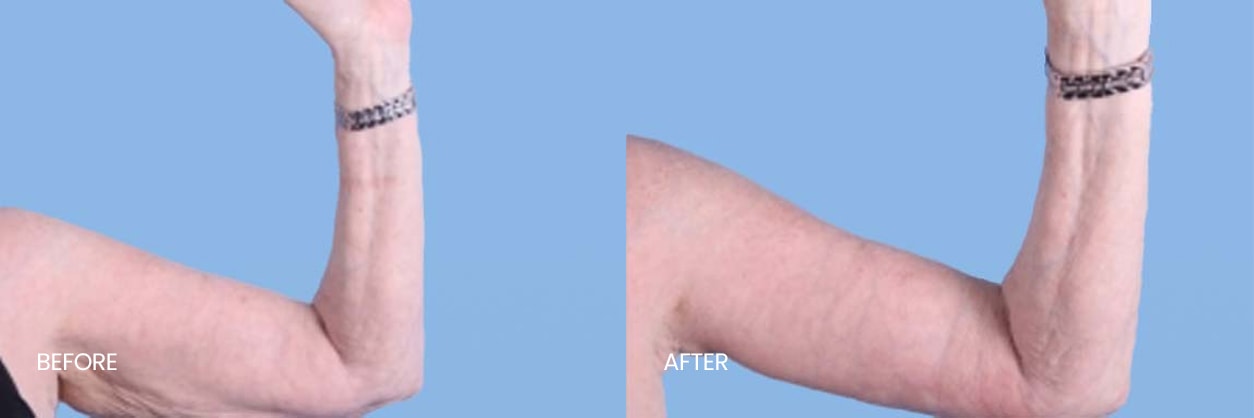 A result from North Texas Plastic Surgery