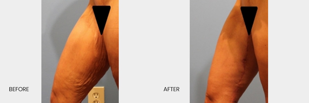 A result from North Texas Plastic Surgery