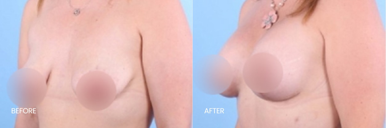 A result from North Texas Plastic Surgery