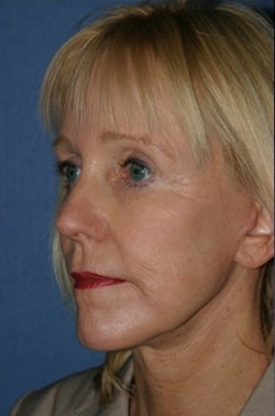 A result from Dr. Andrew M. Wolin: Plastic Surgeon Scottsdale