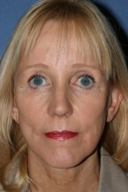 A result from Dr. Andrew M. Wolin: Plastic Surgeon Scottsdale