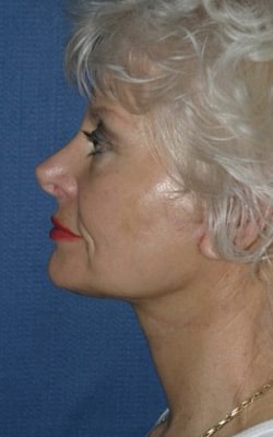 A result from Dr. Andrew M. Wolin: Plastic Surgeon Scottsdale