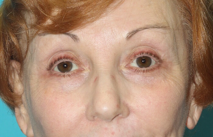 A result from Dr. Andrew M. Wolin: Plastic Surgeon Scottsdale