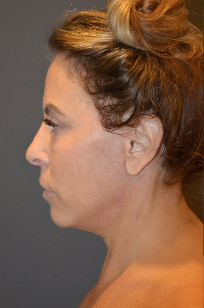 A result from Preminger Plastic Surgery