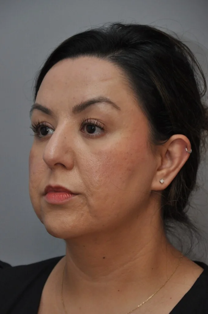 Rhinoplasty result at OC Facial Plastic Surgery