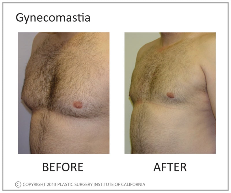 A result from Plastic Surgery Institute of California