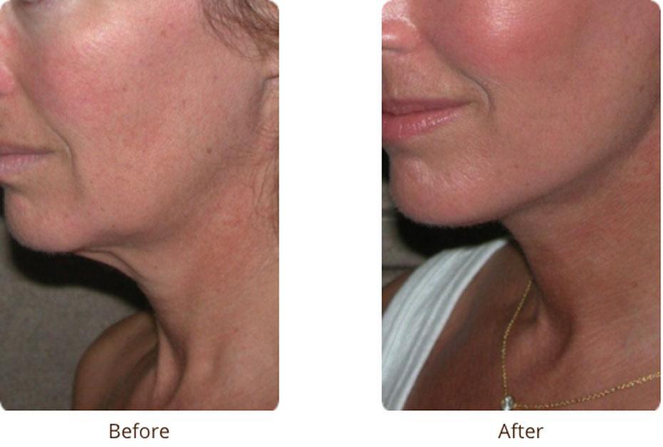 A result from Plastic Surgery Specialists of Boca Raton