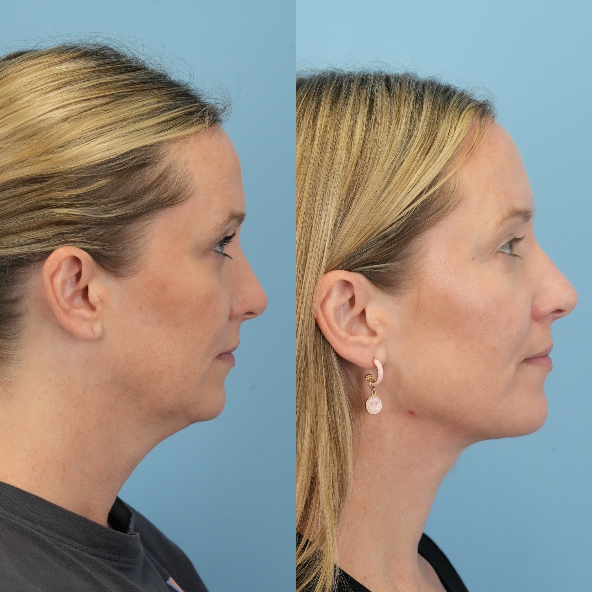A result from Bloom Facial Plastic & Aesthetic Surgery