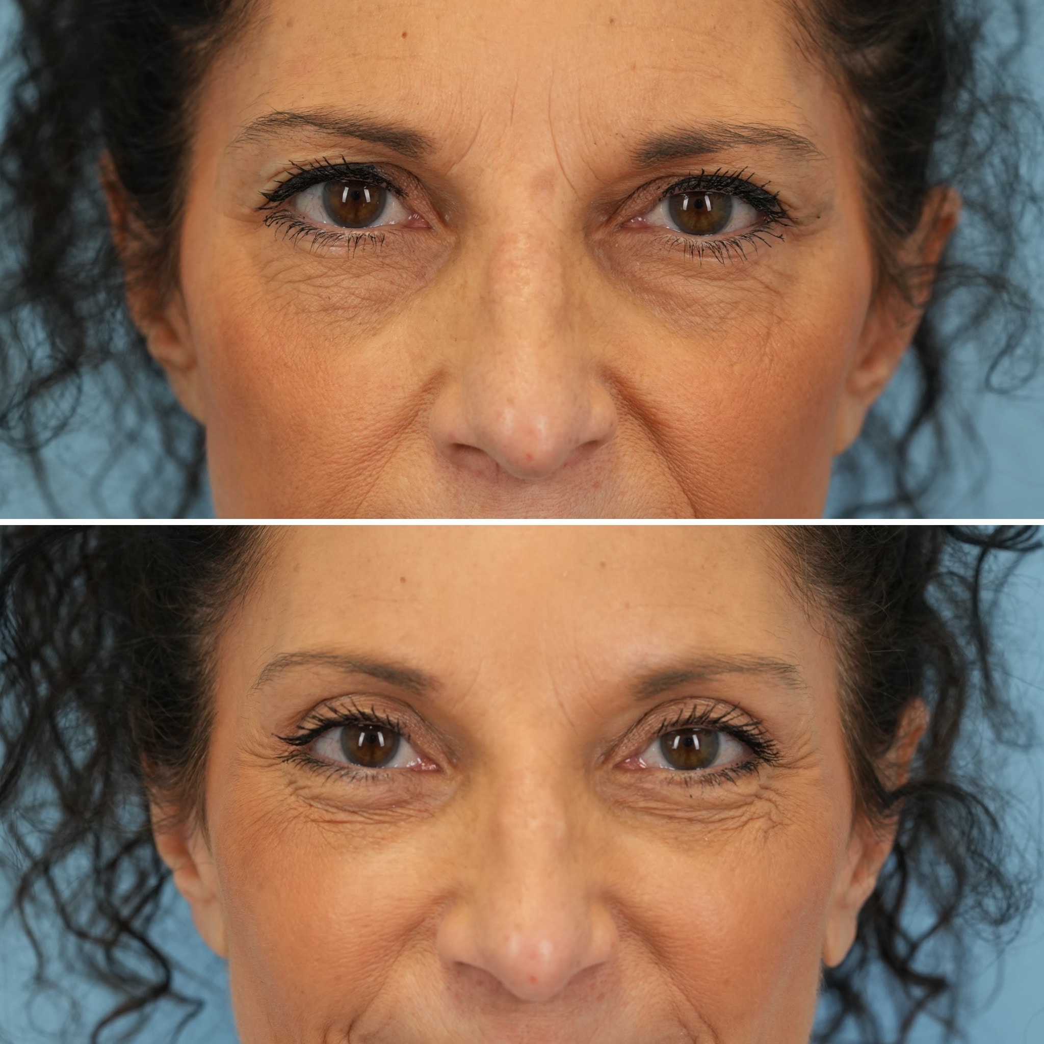 A result from Bloom Facial Plastic & Aesthetic Surgery