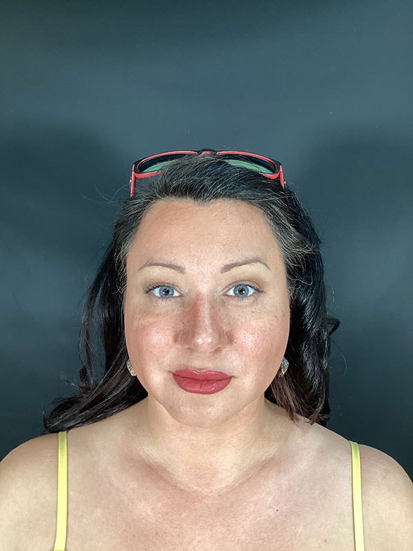 A result from Michael Horn Plastic Surgery & Med Spa