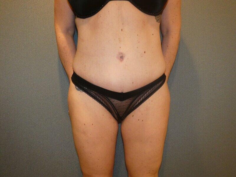 A result from Michael Horn Plastic Surgery & Med Spa