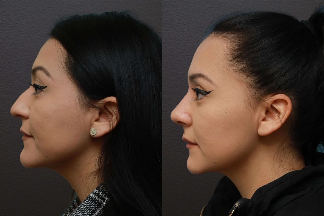 A result from Motakef Plastic Surgery + Med Spa
