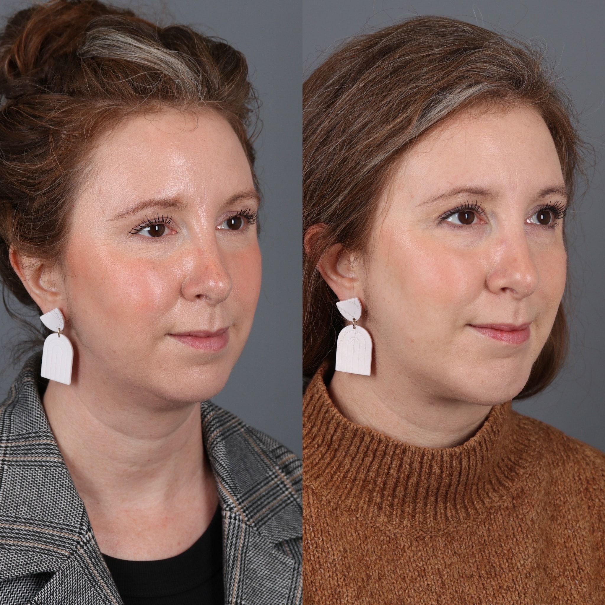 A result from Portland Face Doctor (Peter Vila, MD)