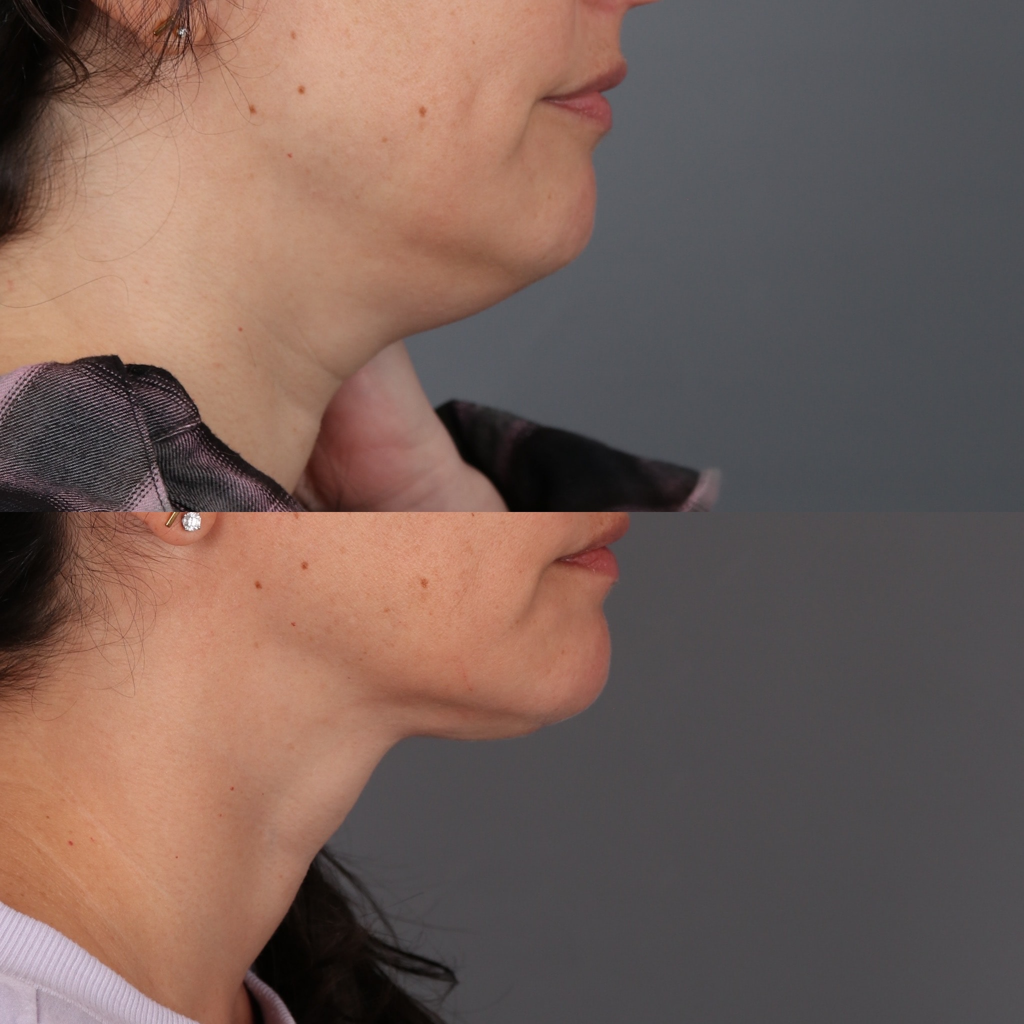 A result from Portland Face Doctor (Peter Vila, MD)