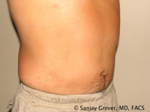 Liposuction result at Grover Surgical Arts
