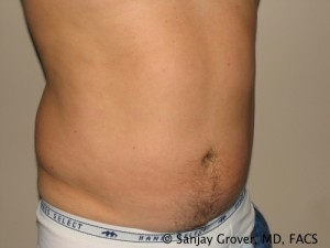 Liposuction before photo