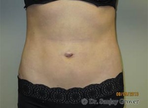 Grover Surgical Arts liposuction after — Newport Beach, CA