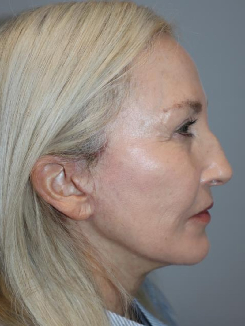 Facelift result at Grover Surgical Arts