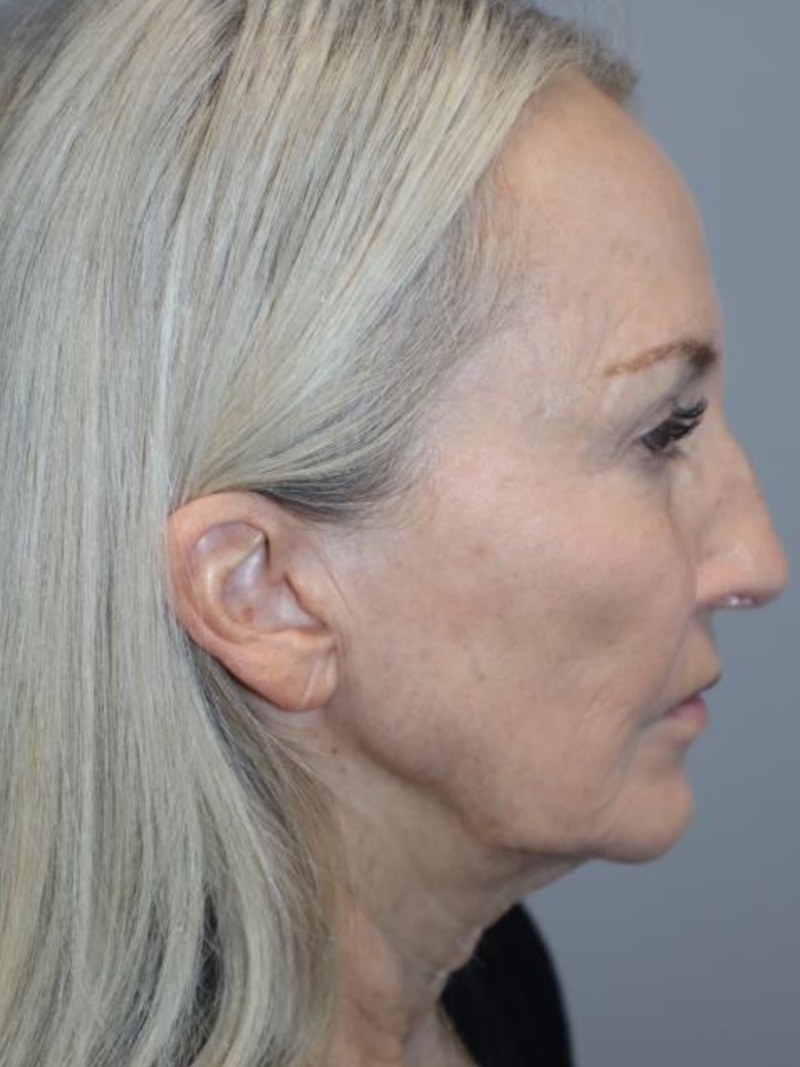 Facelift before photo