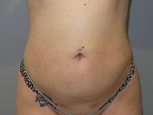 Liposuction result at Grover Surgical Arts