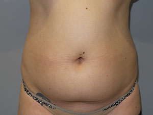 Liposuction before photo