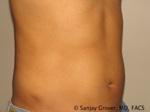 Liposuction result at Grover Surgical Arts