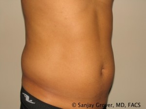 Liposuction before photo