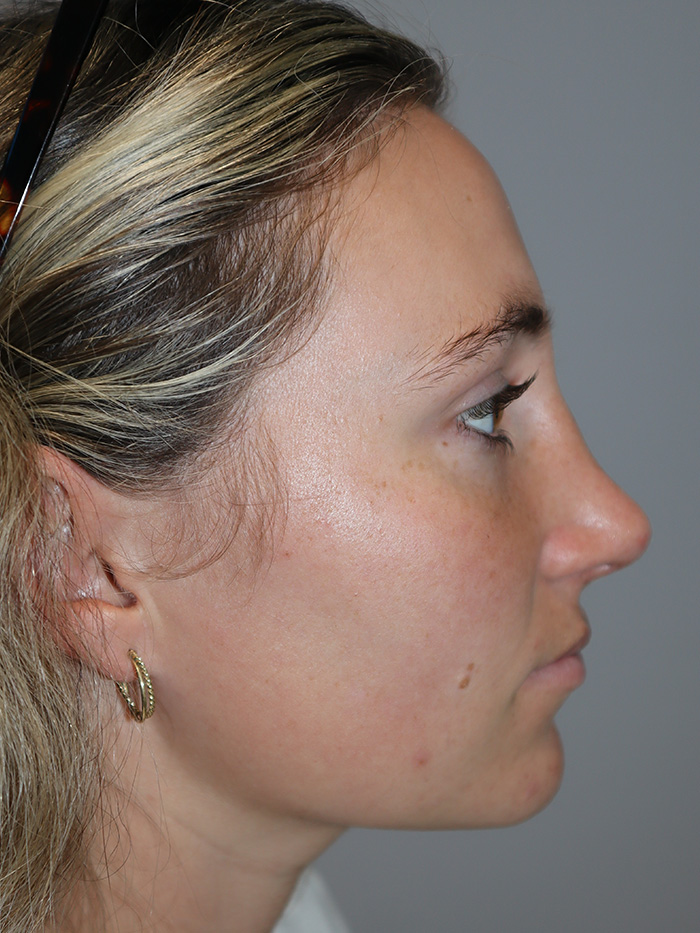 Rhinoplasty result at Grover Surgical Arts
