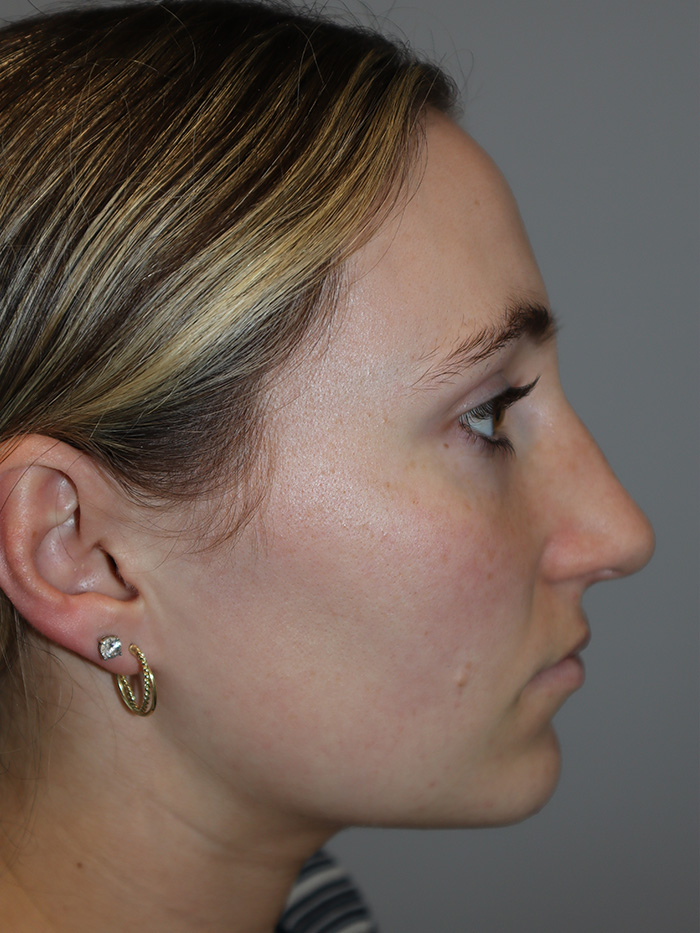 Rhinoplasty before photo