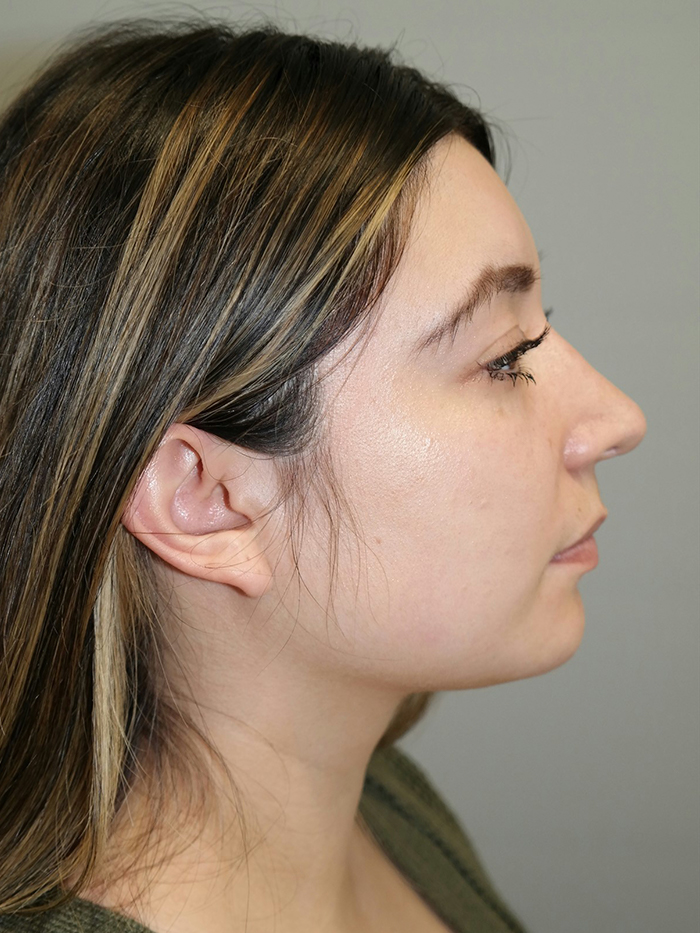 Rhinoplasty result at Grover Surgical Arts