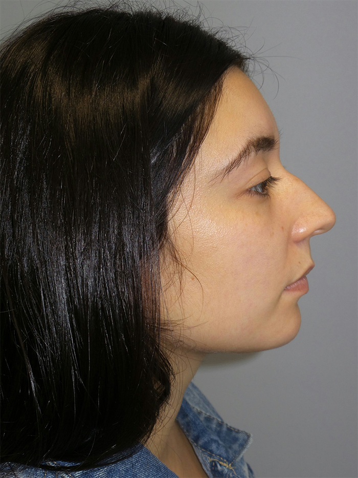 Rhinoplasty before photo