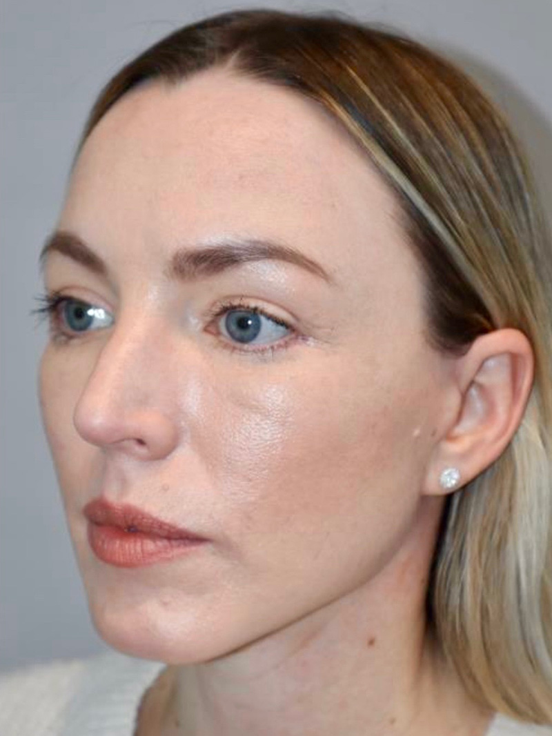 Facelift result at Grover Surgical Arts