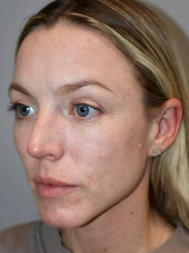 Facelift before photo