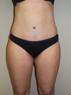 Liposuction result at Grover Surgical Arts