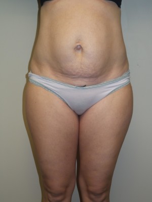 Liposuction before photo