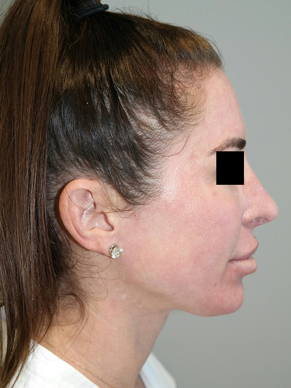 Rhinoplasty result at Grover Surgical Arts