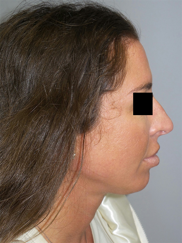 Rhinoplasty before photo
