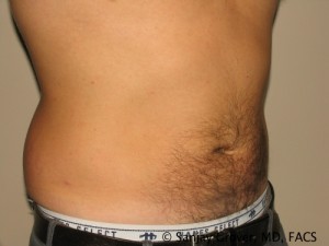 Liposuction result at Grover Surgical Arts