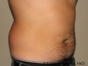 Liposuction before photo