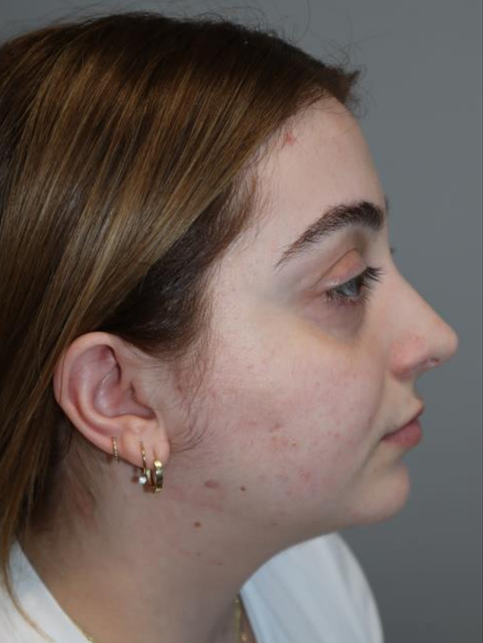 Rhinoplasty result at Grover Surgical Arts