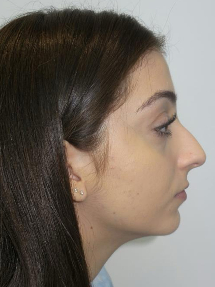 Rhinoplasty before photo