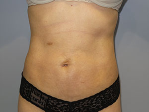 Liposuction result at Grover Surgical Arts